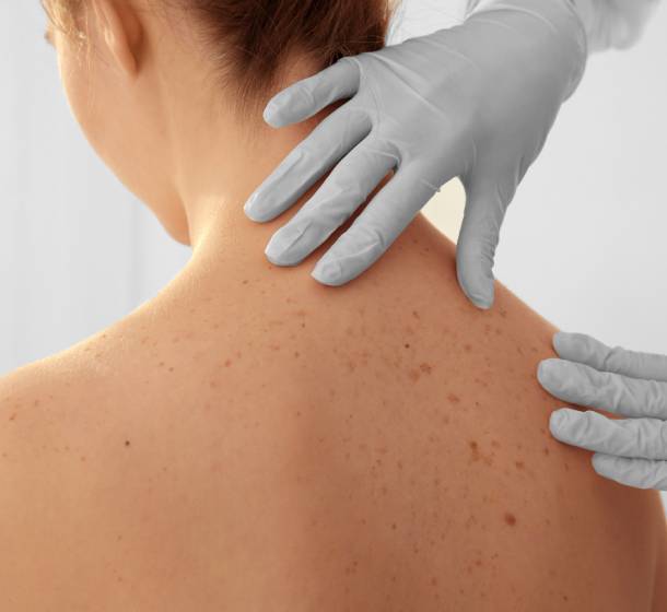 Woman getting skin on back checked out by a dermatologist
